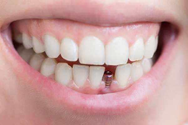 dental implants Newcastle