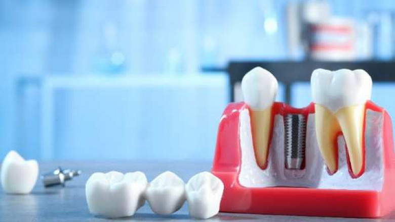 Choosing the Right Dental Implant Type in Newcastle