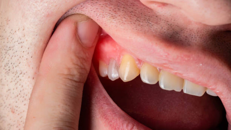 How Emergency Dentists Manage Severe Toothaches Effectively
