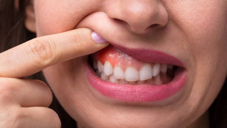 Why Immediate Dental Care Can Prevent Long-Term Oral Damage