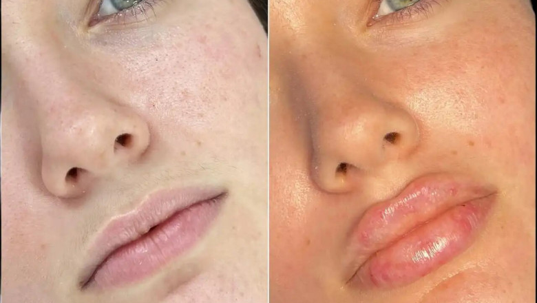 Best Plastic Surgeon in dubai for Fillers: The Importance of Qualified Practitioners
