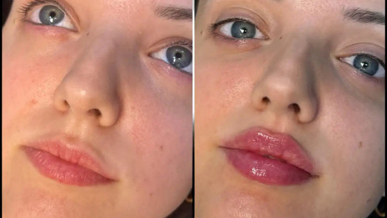 The Benefits of Choosing the Best Plastic Surgeon in Dubai for Non-Surgical Fillers